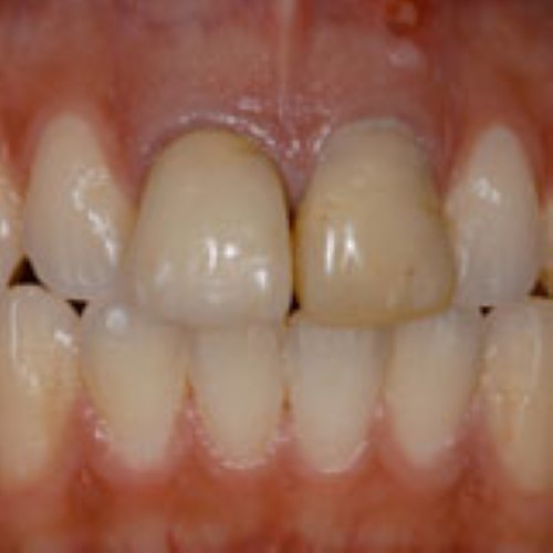 Case presentation - Replacement of two incisors in a young male